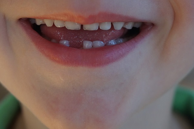Milchzähne - Zähne auf Probe? Oder doch wichtig fürs Erwachsenenalter?