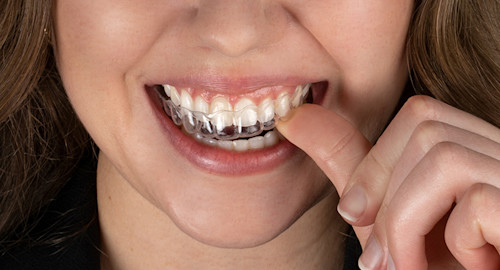 Zahnschienen auf Rezept? So bekommst Du Deine Aligner!