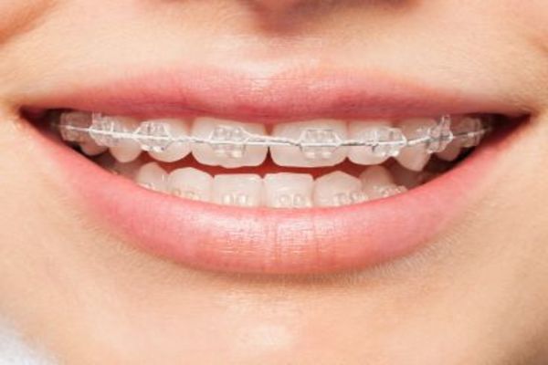 Apparecchio fisso in ceramica