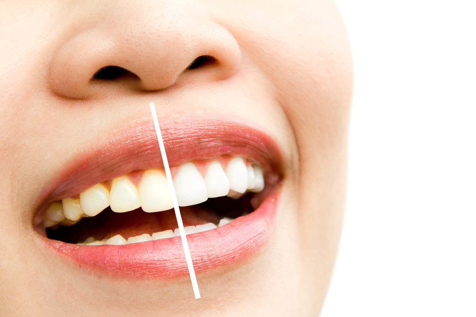 Dental Bonding für schönere Zähne - unkompliziert und kostengünstig!
