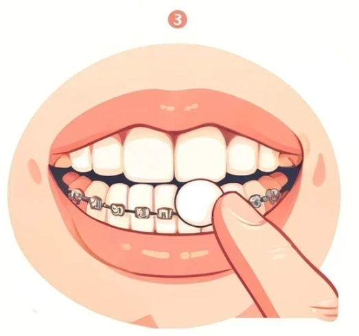 Illustrazione applicazione cera ortodontica su apparecchio fisso