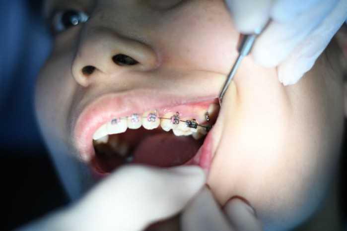 Personne chez l'orthodontiste pour le réglage de bagues (ou appareil dentaire fixe)