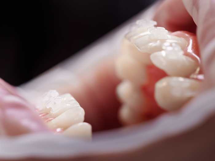 foto de dientes con ataches dentales