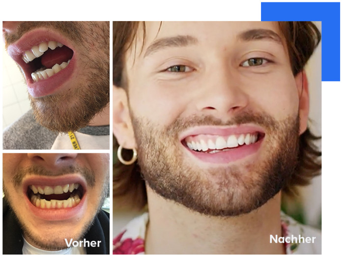 Résultats avant-après de la correction d'une supraclusion grâce aux aligneurs dentaires DR SMILE