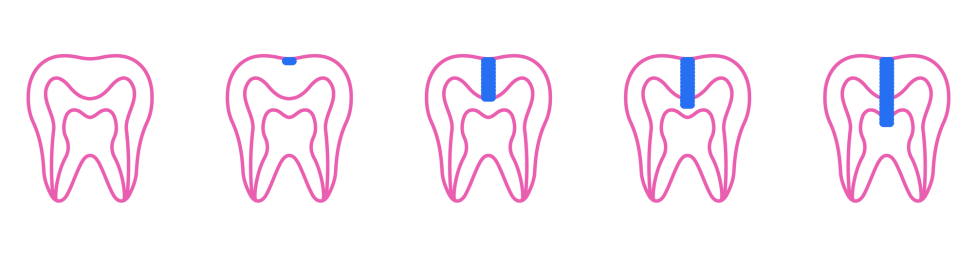 Carie ai denti: cos'è? Tipi, sintomi, cure