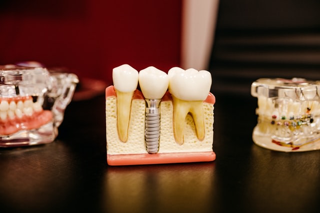 teeth implant