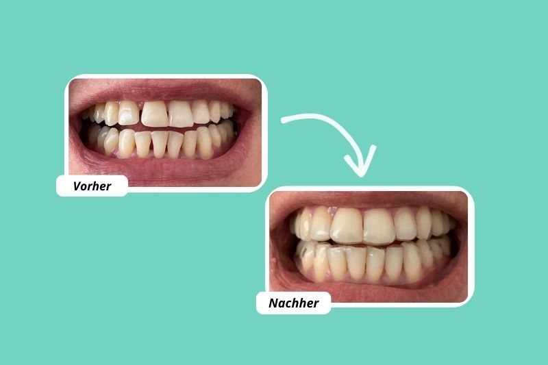 Vorher / Nachher schwarze Dreiecke