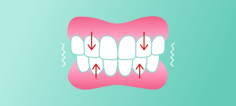 Illustration with bruxing movements