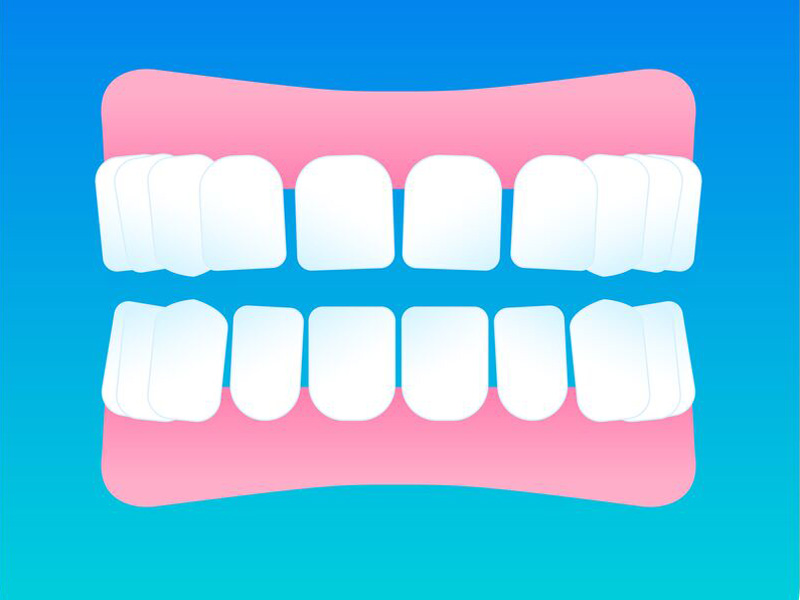 Ilustración de un diastema dental
