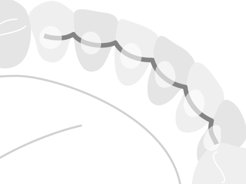 Illustration-IPR-fixedretainer1