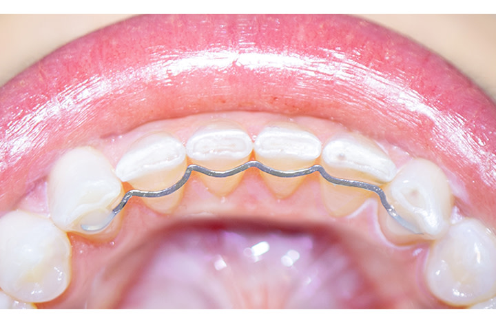 DrSmile Retainer-Draht