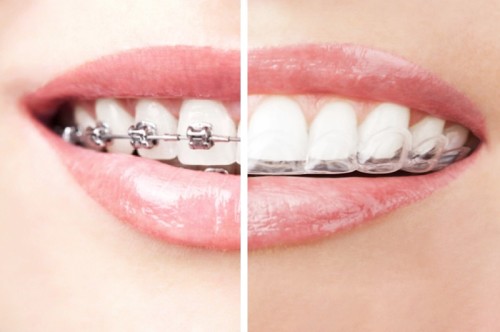 Rodzaje aparatów ortodontycznych - jaki wybrać?