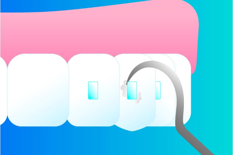 Cómo se quitan los ataches dentales