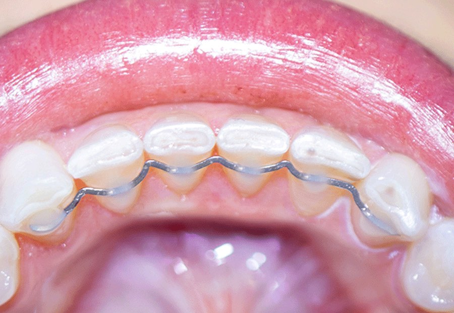 DR SMILE Retainer: Dauerretainer aus Draht