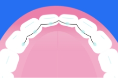 Fixed Retainer AT image 2 Desktop