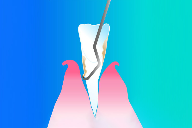 Curetaje dental: ¿qué es y cómo se realiza?