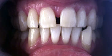 Diastema: prima