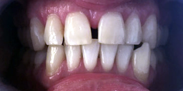 Malocclusion dentaire occlusion croisée avec diastème
