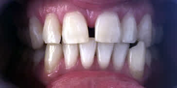 Zahnfehlstellung Kreuzbiss mit Zahnlücke