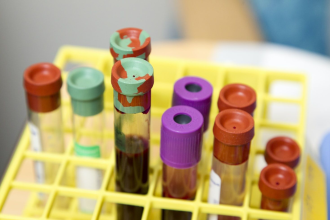 Medical vials containing blood samples sit upright in a yellow tray 