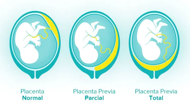Diferencias de placenta normal, placenta previa parcial y placenta previa total