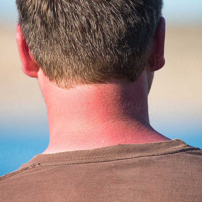 Image of a sunburn on a person's neck