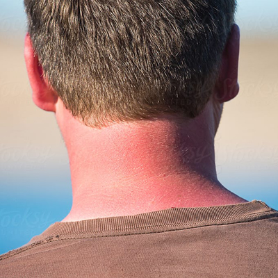 Image of a sunburn on a person's neck