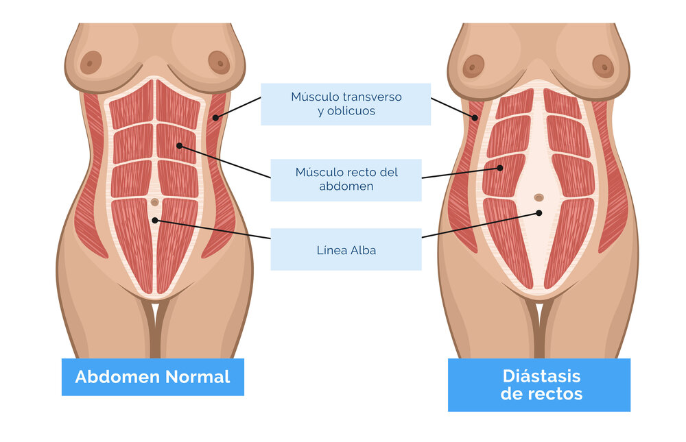 distasis abdominal