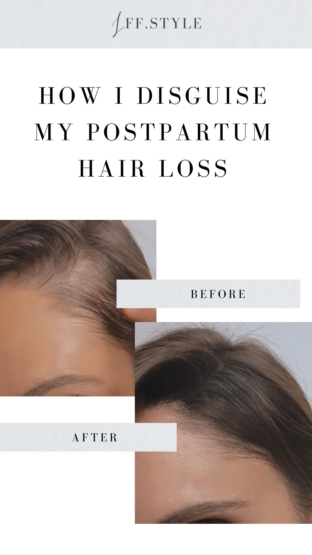 Motherhood-Mom Talk-postpartum hair loss 3