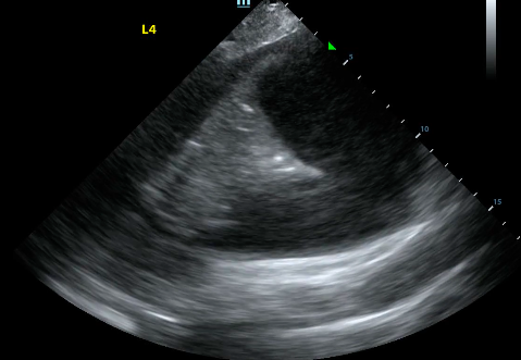 Cover Image for Pleural effusions on lung ultrasound - determining the diagnosis, etiology, and size 