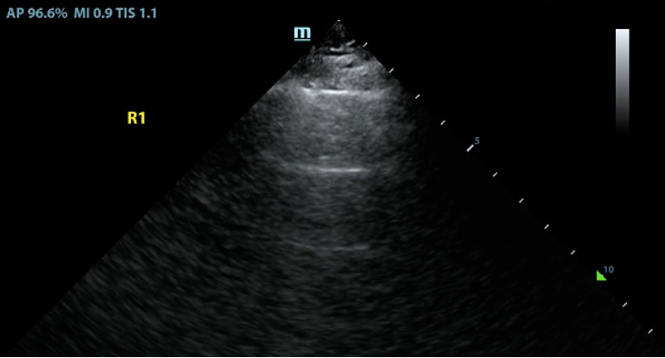 Cover Image for Lung ultrasound artifacts: A lines, B lines, Z lines, and E lines