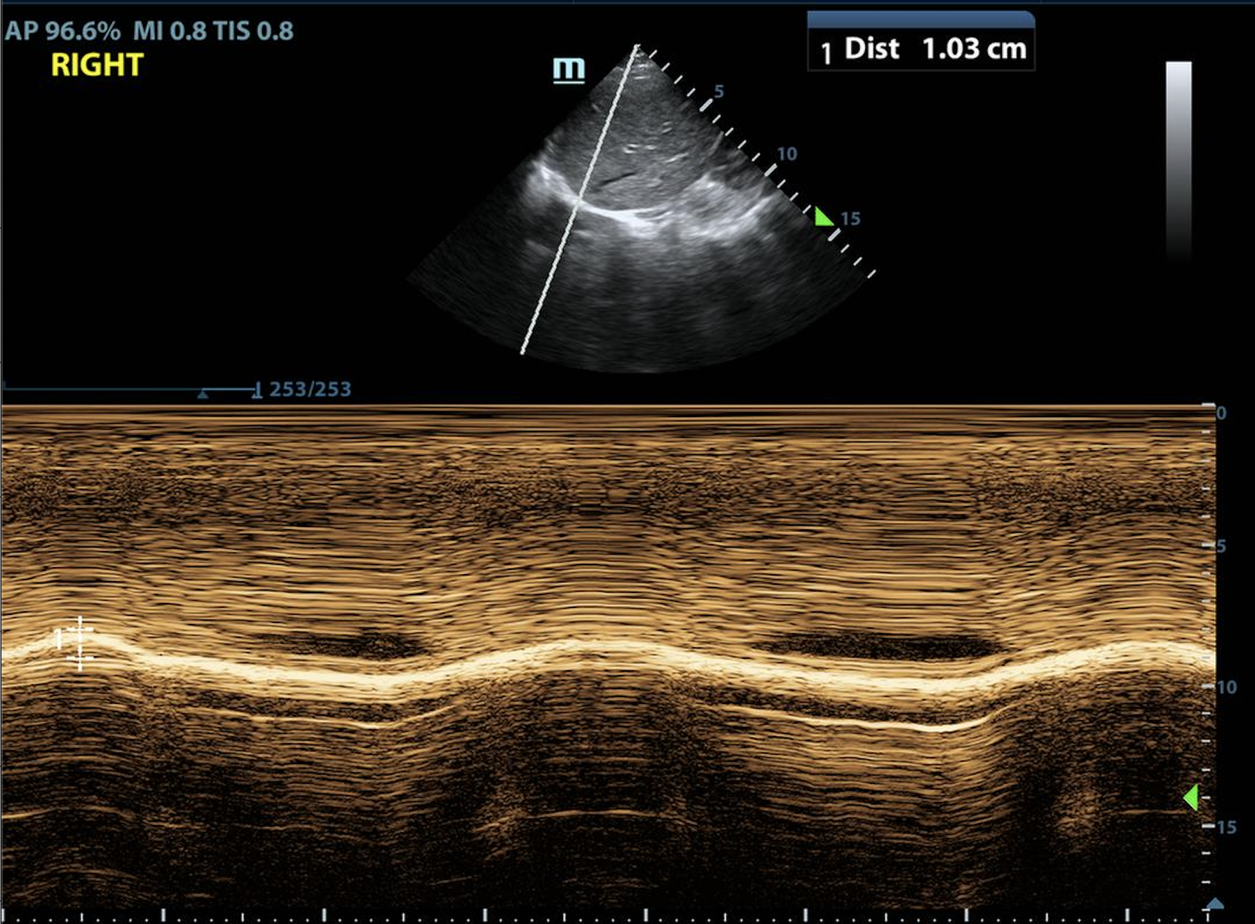 Cover Image for Diaphragmatic ultrasound to diagnose weaning failure from mechanical ventilation