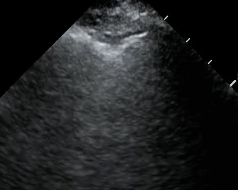 Cover Image for The pleural line - understanding pleural line abnormalities on lung ultrasound