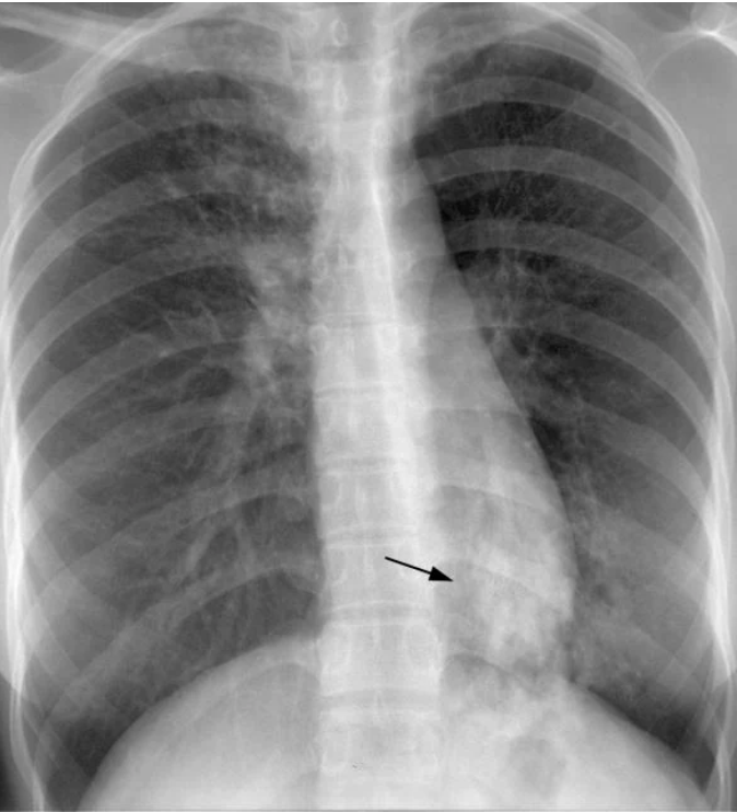 Cover Image for Tuberculosis on Lung Ultrasound