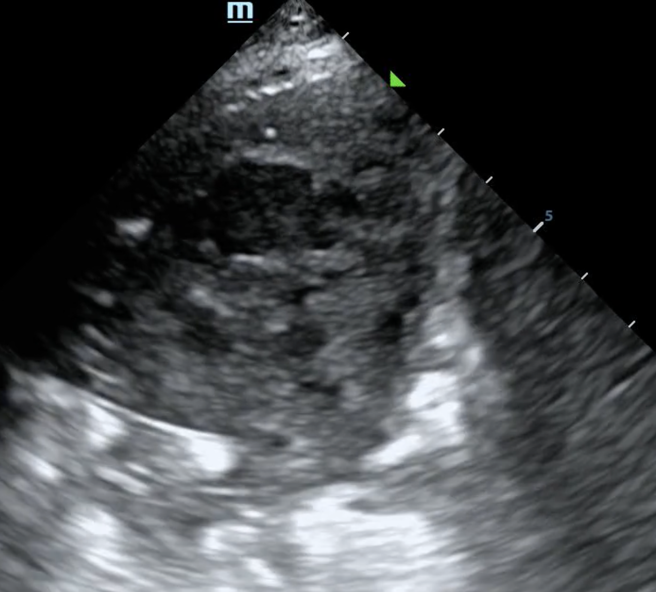 Cover Image for Diagnosing and monitoring tuberculosis on lung ultrasound