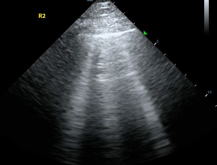 Cover Image for B lines on lung ultrasound - not just heart failure 