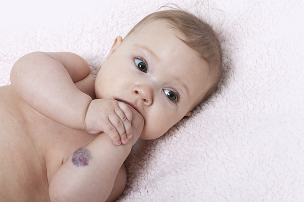 Know about birth marks from Pampers PH