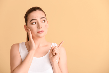 Uma jovem rapariga a pensar e tocar na sua cara na qual se nota a acne