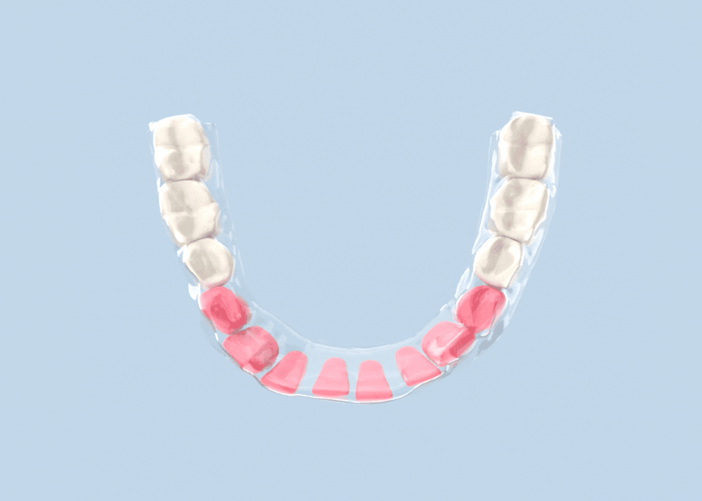 Candid Clear Aligners Ask An Orthodontist How Is A Treatment Plan