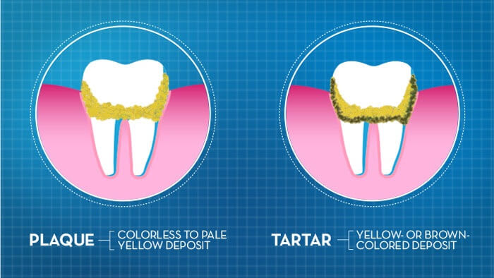 Differentiating Between Plaque and Tartar