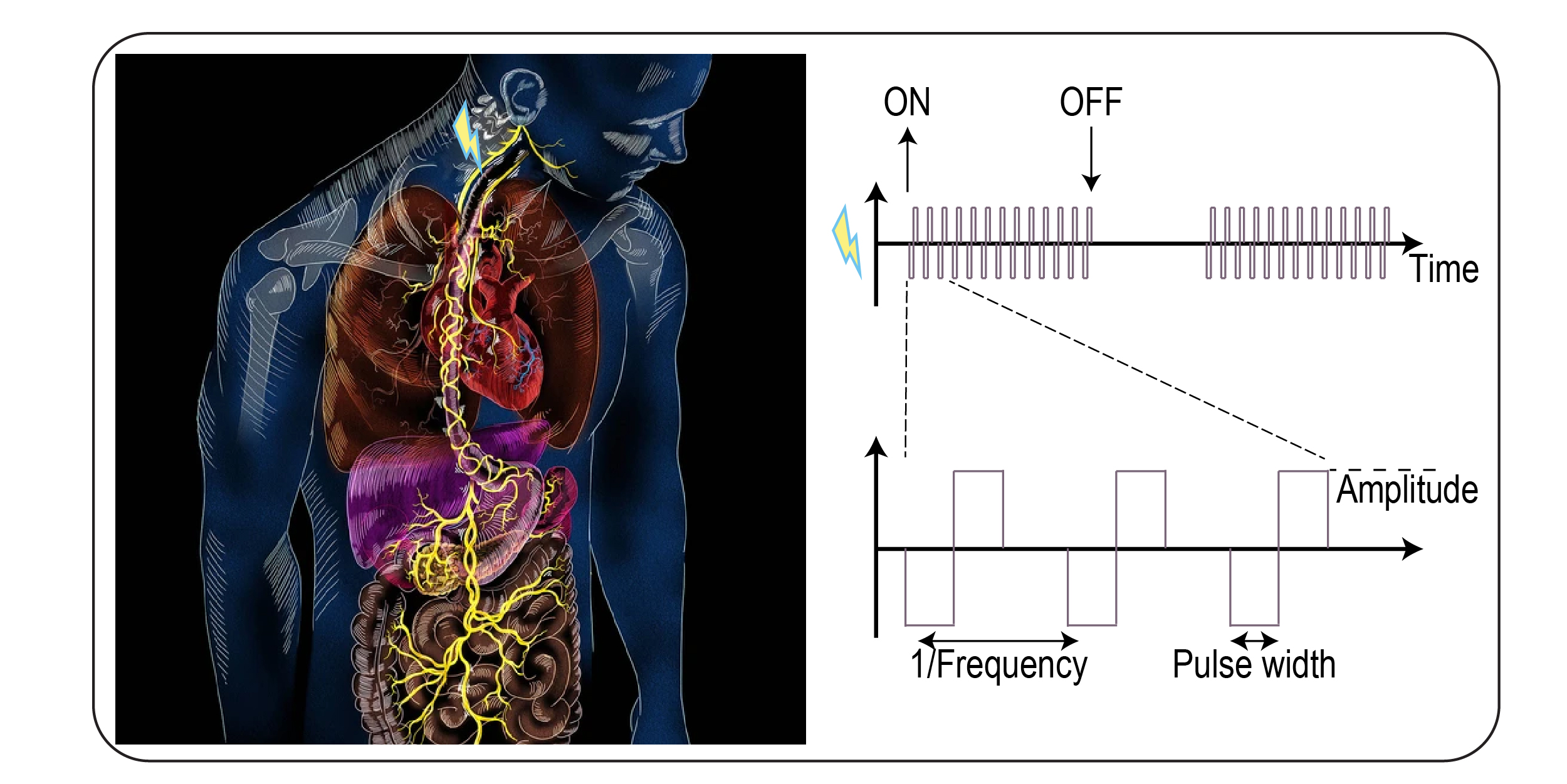 Vagus nerve stimulation