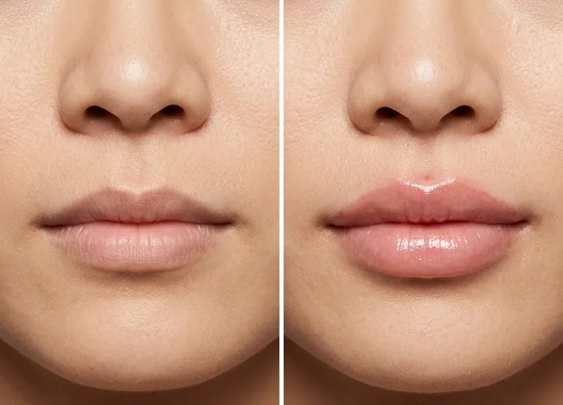 Lip Flip vs Filler: Which One Is Actually Right for You?