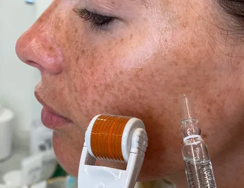 How Much Does Microneedling Cost? A Real Breakdown Before You Book