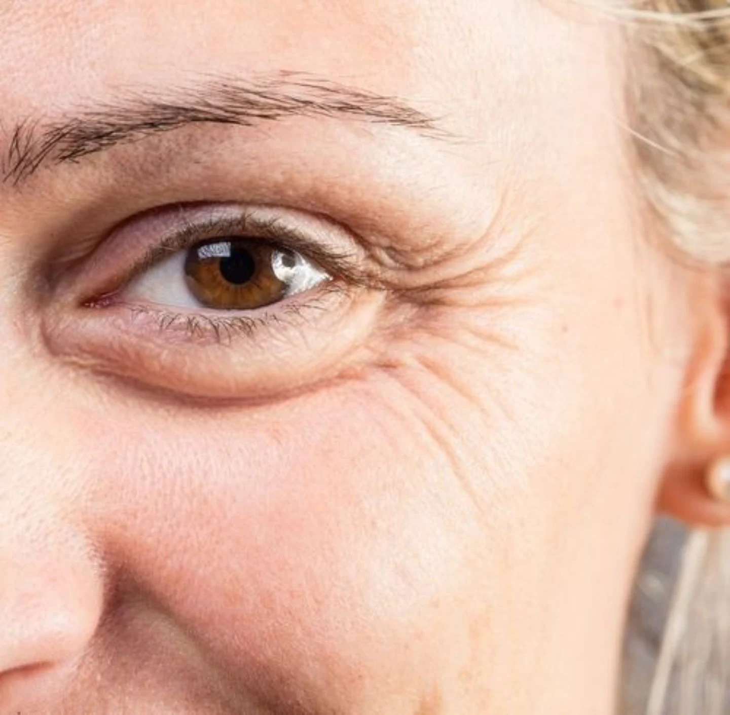 Guide on crow’s feet cause, prevention and treatment