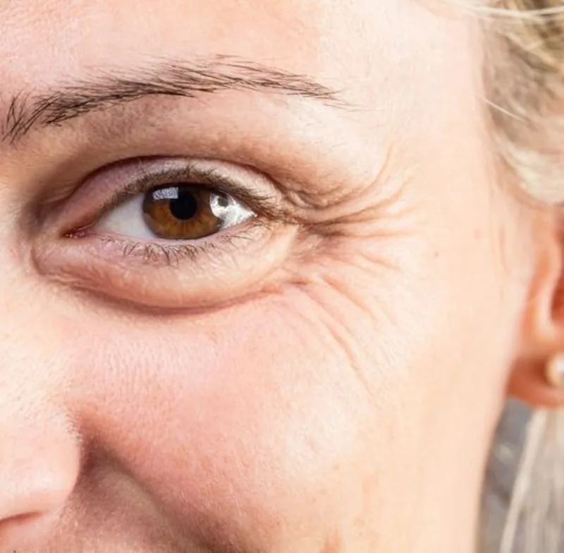 What Are Crow's Feet? Causes, Prevention & Treatment Options