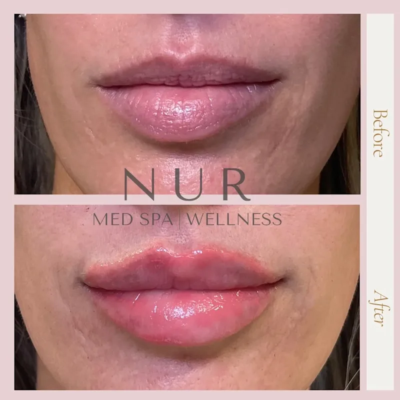 Lip Filler Swelling Stages: What Your Lips Really Look Like While Healing