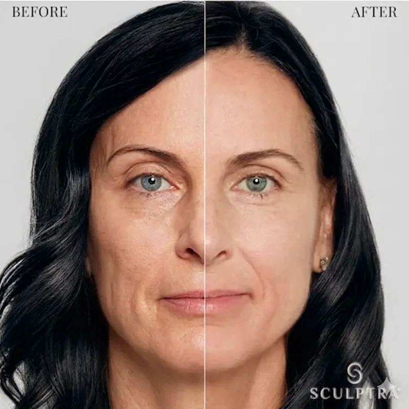 How Long Does Sculptra Last?