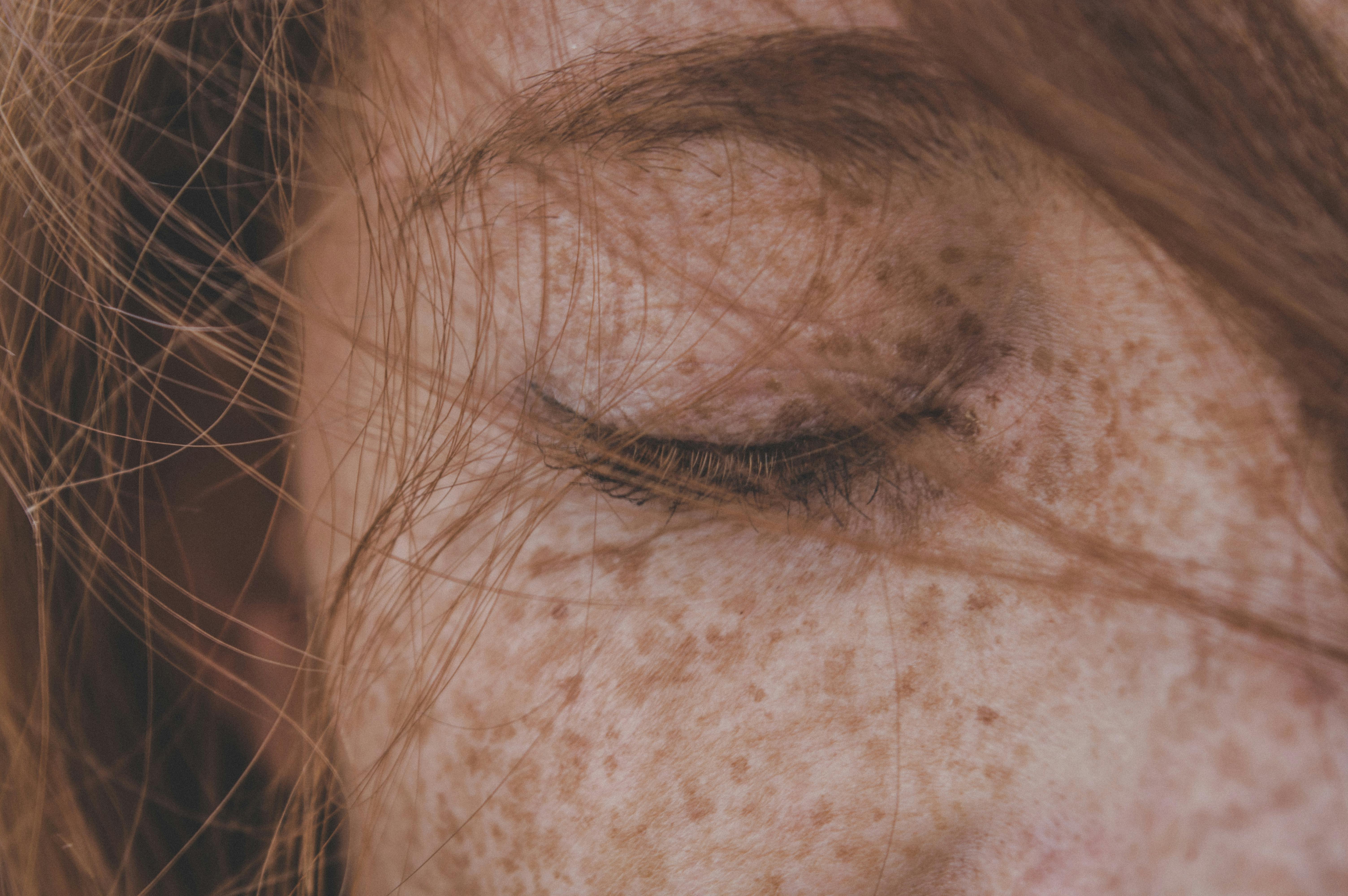 3 Effective Treatments for Hyperpigmentation