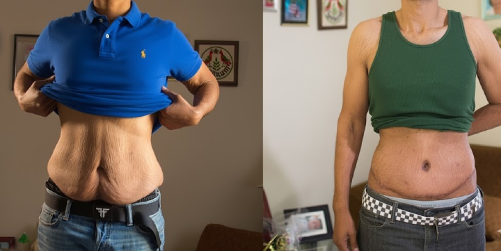 How to Tighten Loose Skin After Weight Loss?