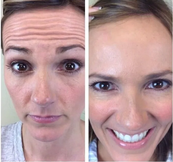 forehead wrinkles before and after